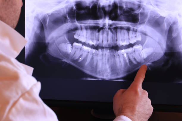 Best Knocked-Out Tooth (Avulsed Tooth) Treatment in Winterville, GA